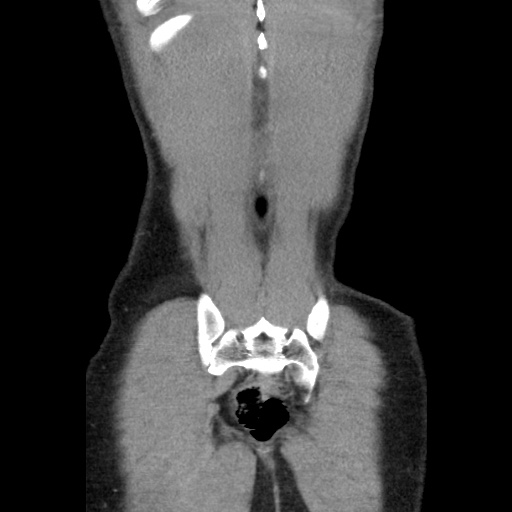 File:Appendicitis complicated by post-operative collection (Radiopaedia 35595-37113 B 49).jpg