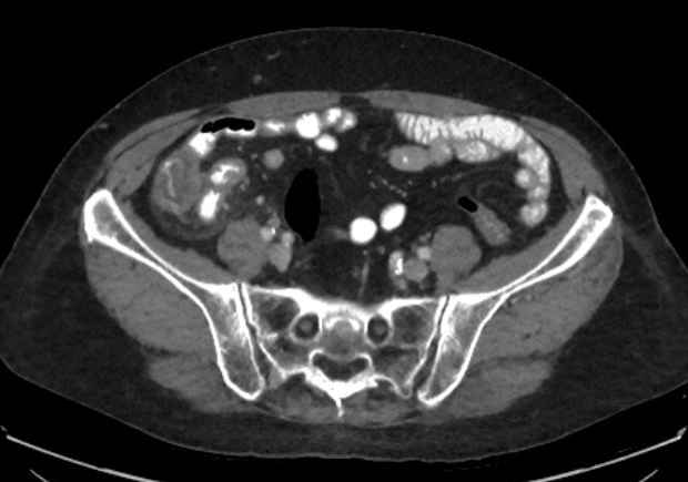 Appendicitis due to chicken fibula (Radiopaedia 74314-85198 A 23).jpg