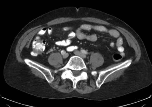 Appendicitis due to chicken fibula (Radiopaedia 74314-85198 A 9).jpg