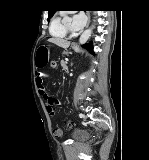 File:Appendicitis with localized perforation and abscess formation (Radiopaedia 49035-54130 C 38).jpg