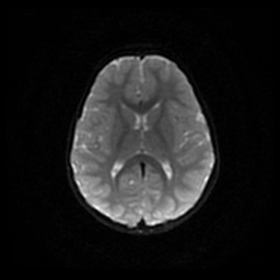 Arachnoid cyst - middle cranial fossa (Radiopaedia 86780-102938 Axial DWI 42).jpg