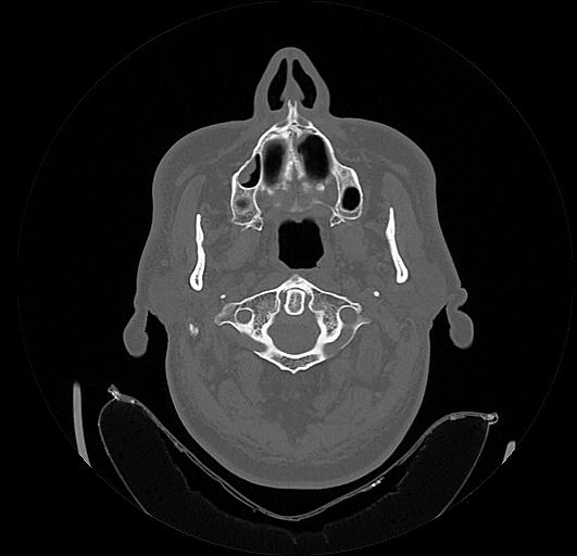 Arcuate foramen (Radiopaedia 89833-106944 Axial bone window 25).jpg