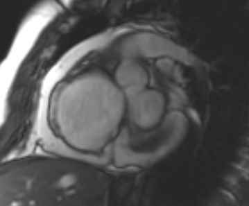 Arrhythmogenic right ventricular cardiomyopathy (Radiopaedia 69431-79307 Short axis cine 218).jpg
