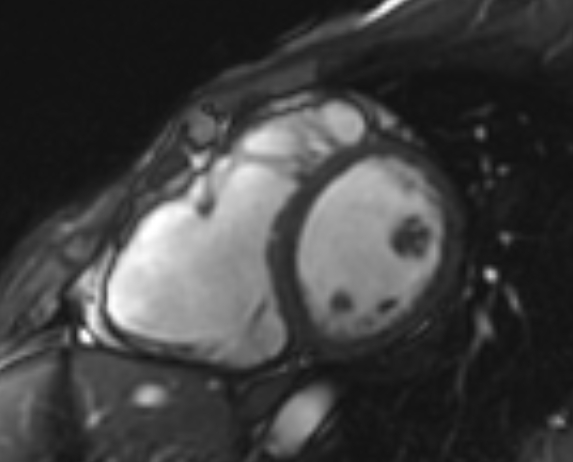 Arrhythmogenic right ventricular cardiomyopathy (Radiopaedia 69564-79464 short axis cine 159).jpg