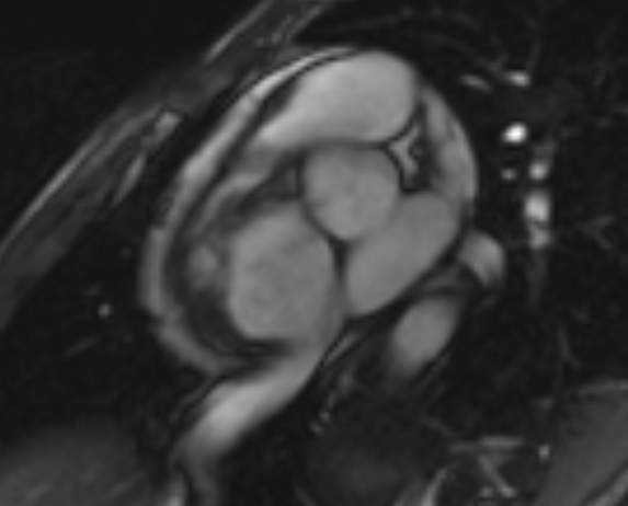 Arrhythmogenic right ventricular cardiomyopathy (Radiopaedia 69564-79464 short axis cine 247).jpg