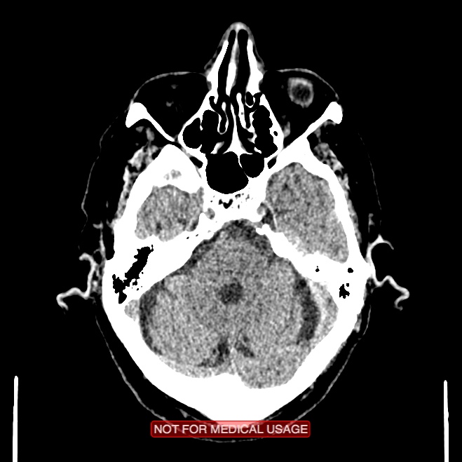 Artery of Percheron infarction (Radiopaedia 28679-28967 Axial non-contrast 32).jpg