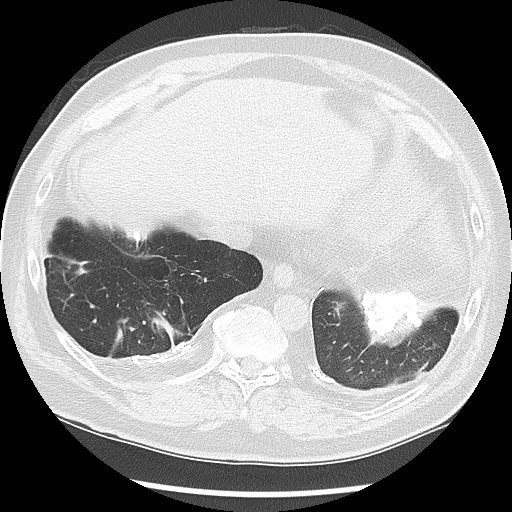 Asbestos-related pleural disease (Radiopaedia 74366-85250 Axial lung window 94).jpg