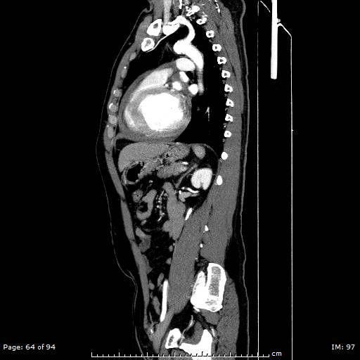 File:Ascending aortic aneurysm (Radiopaedia 50086-55404 C 46).jpg