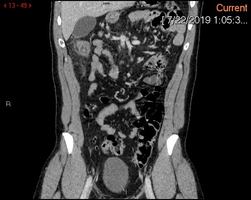 File:Ascending colonic diverticulum mimicking acute appendicitis (Radiopaedia 69943-80198 B 49).jpg