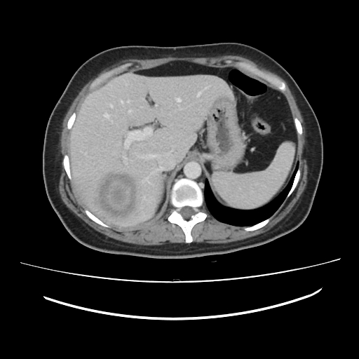 Ascending retrocecal appendicitis with liver abscesses (Radiopaedia 60066-67615 B 22).jpg
