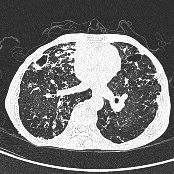 Aspergilloma- with Monod sign (Radiopaedia 44737-48532 Axial lung window 152).jpg