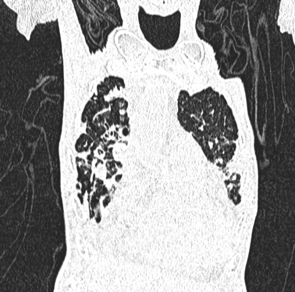 Aspergilloma- with Monod sign (Radiopaedia 44737-48532 Coronal lung window 152).jpg