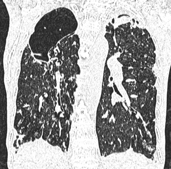 Aspergilloma- with Monod sign (Radiopaedia 44737-48532 Coronal lung window 304).jpg