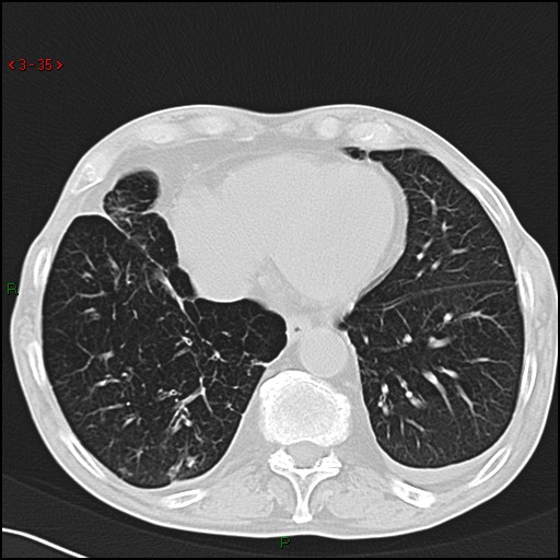 File:Aspergilloma (Radiopaedia 14842-14787 Axial lung window 35).jpg