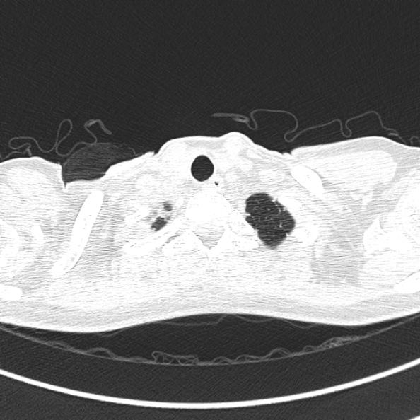 Aspergilloma (Radiopaedia 26223-26347 Axial lung window 3).jpg