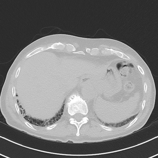 Aspergilloma on background pulmonary fibrosis (Radiopaedia 60942-68757 A 48).jpg
