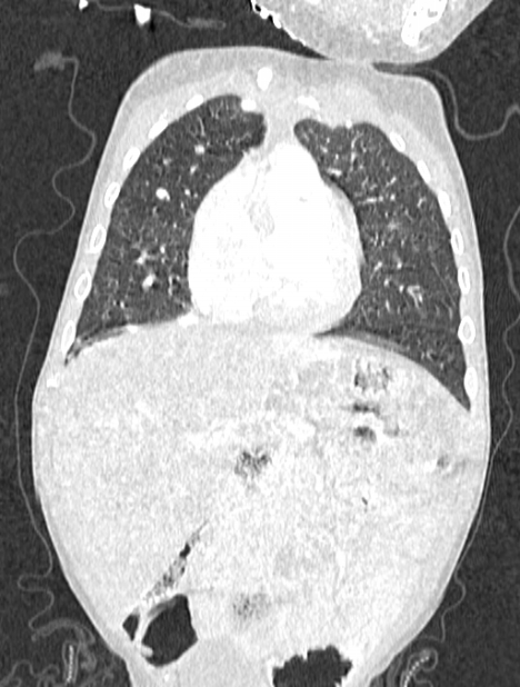 Asplenia syndrome (Radiopaedia 73083-83792 Coronal lung window 42).jpg