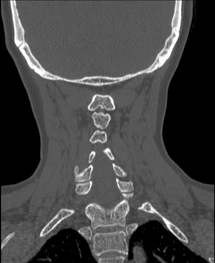 Atlanto-occipital assimilation with basilar invagination (Radiopaedia 70122-80188 Coronal bone window 163).jpg