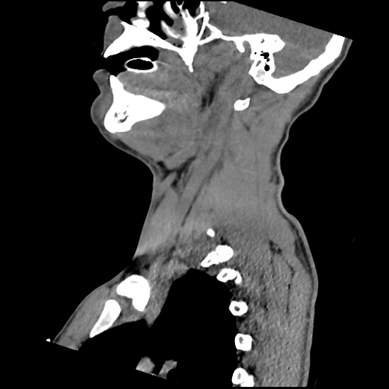File:Atlanto-occipital dissociation (Traynelis type 1), C2 teardrop fracture, C6-7 facet joint dislocation (Radiopaedia 87655-104061 D 28).jpg