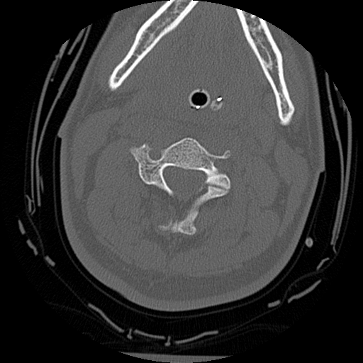Atlanto-occipital dissociation injury (Radiopaedia 29274-29698 Axial bone window 30).png