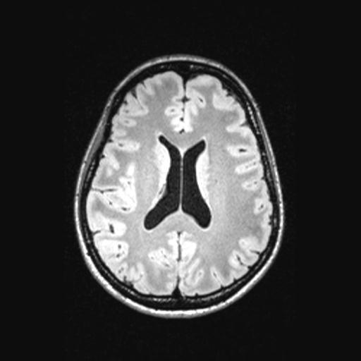 Atretic encephalocoele with inferior vermis hypoplasia (Radiopaedia 30443-31108 Axial 97).jpg