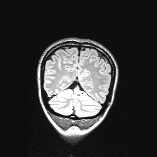 Atretic encephalocoele with inferior vermis hypoplasia (Radiopaedia 30443-31108 Coronal FLAIR 42).jpg