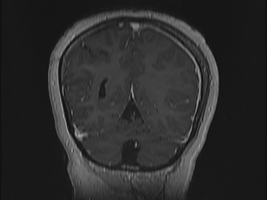 Atypical meningioma (Radiopaedia 62985-71406 Coronal T1 C+ 103).jpg