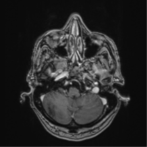 Atypical meningioma (WHO Grade II) (Radiopaedia 54742-60979 Axial T1 C+ 10).png