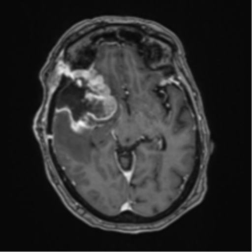 Atypical meningioma (WHO Grade II) (Radiopaedia 54742-60981 Axial T1 C+ 30).png