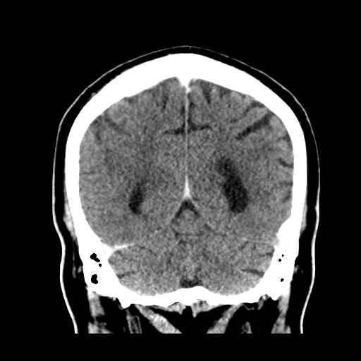 Atypical meningioma (WHO grade II) with brain invasion (Radiopaedia 57767-64728 Coronal C+ 47).png