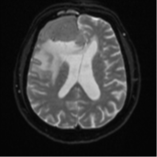 File:Atypical meningioma (WHO grade II) with brain invasion (Radiopaedia 57767-64729 Axial DWI 18).png