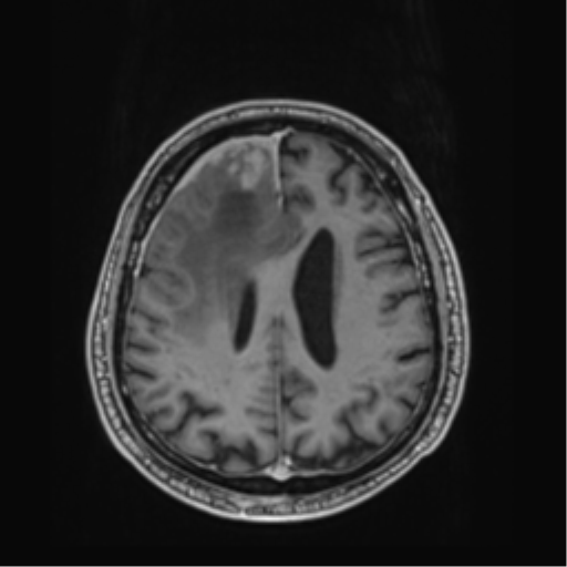File:Atypical meningioma (WHO grade II) with brain invasion (Radiopaedia 57767-64729 Axial T1 C+ 34).png