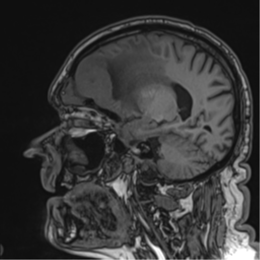 Atypical meningioma (WHO grade II) with brain invasion (Radiopaedia 57767-64729 Sagittal T1 43).png