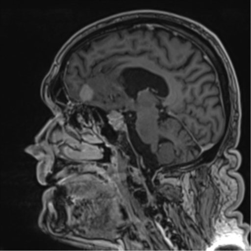 Atypical meningioma (WHO grade II) with brain invasion (Radiopaedia 57767-64729 Sagittal T1 C+ 33).png