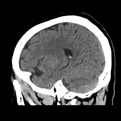 Atypical meningioma (WHO grade II) with osseous invasion (Radiopaedia 53654-59715 C 37).png