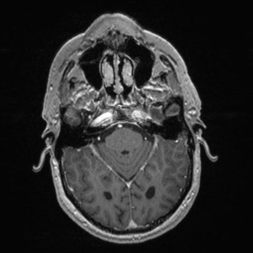 Atypical meningioma (grade II) - en plaque (Radiopaedia 29633-30147 Axial T1 C+ 62).jpg