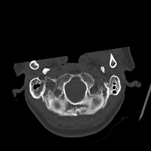 Atypical meningioma with skull invasion (Radiopaedia 34357-35649 Axial bone window 10).png