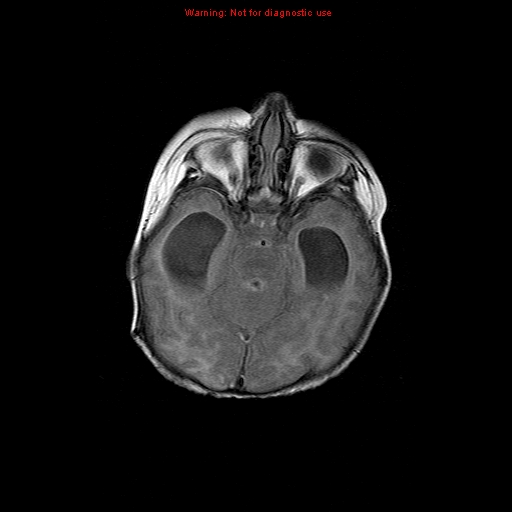 File:Atypical teratoid rhabdoid tumor (Radiopaedia 10712-11183 Axial FLAIR 12).jpg