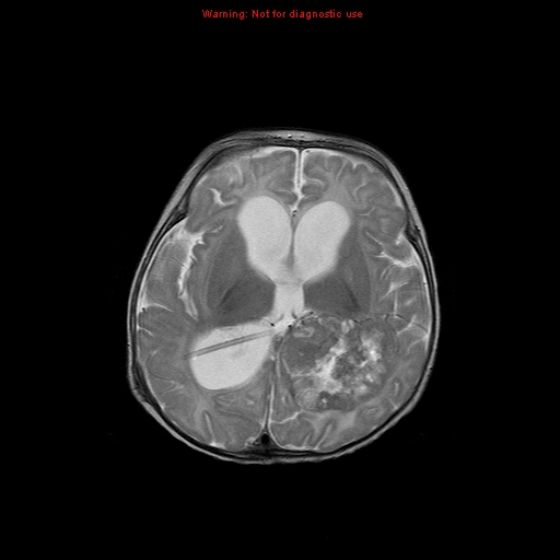 File:Atypical teratoid rhabdoid tumor (Radiopaedia 10712-11183 Axial T2 8).jpg