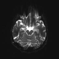 Autoimmune limbic encephalitis (Radiopaedia 30363-31005 Axial B0 and DWI 13).jpg