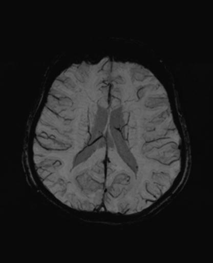 Autoimmune limbic encephalitis (Radiopaedia 30363-31005 SWI - mIP 46).jpg