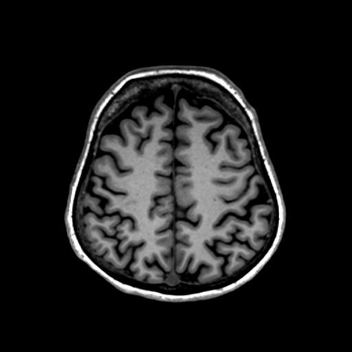 Autoimmune limbic encephalitis (Radiopaedia 30363-31005 T1 Axial 1mm 114).jpg