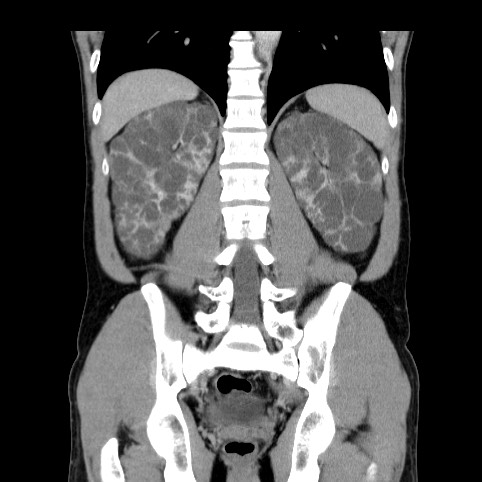 Autosomal dominant polycystic kidney disease (Radiopaedia 66349-75582 A 63).jpg