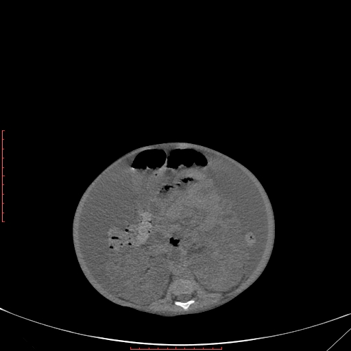 Autosomal recessive polycystic kidney disease associated with Caroli disease (Radiopaedia 61932-69984 Axial non-contrast 226).jpg