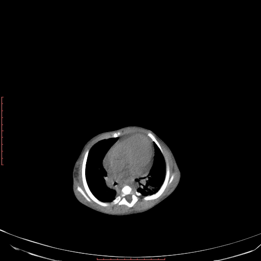 File:Autosomal recessive polycystic kidney disease associated with Caroli disease (Radiopaedia 61932-69984 B 57).jpg