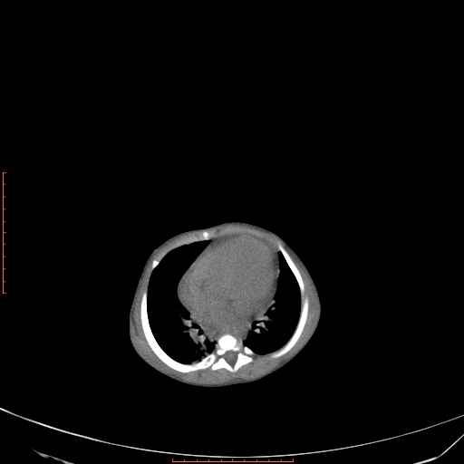 File:Autosomal recessive polycystic kidney disease associated with Caroli disease (Radiopaedia 61932-69984 B 67).jpg