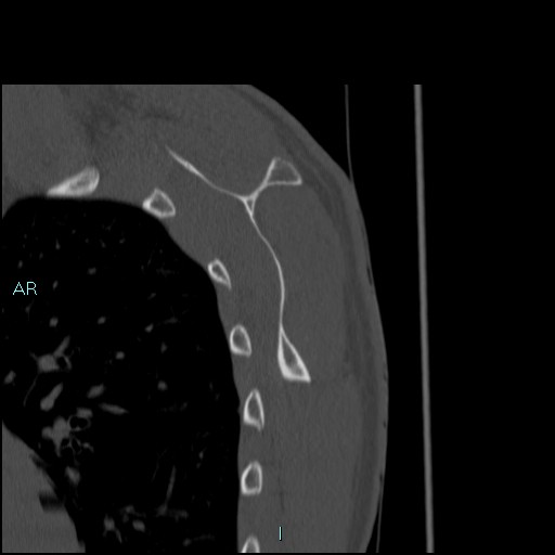 Avascular necrosis after fracture dislocations of the proximal humerus (Radiopaedia 88078-104653 Sagittal bone window 64).jpg