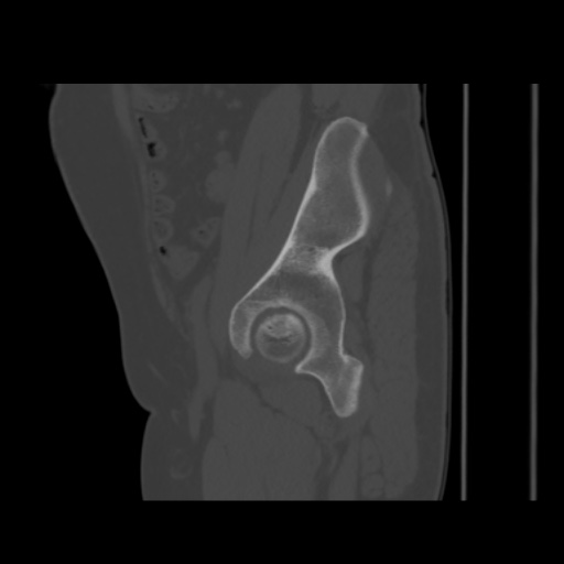 Avascular necrosis of the hip (Radiopaedia 61503-69467 B 18).jpg