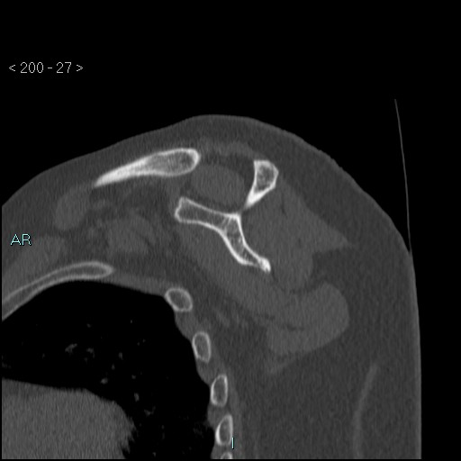 Avascular necrosis of the shoulder - Cruess stage I (Radiopaedia 77674-89887 Sagittal bone window 26).jpg