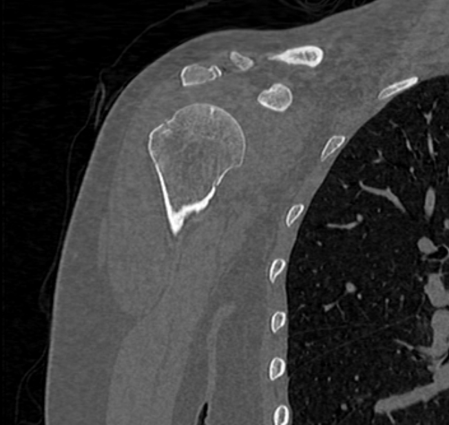 Avulsion fracture - greater tuberosity of humerus (Radiopaedia 71216-81514 Coronal bone window 19).jpg